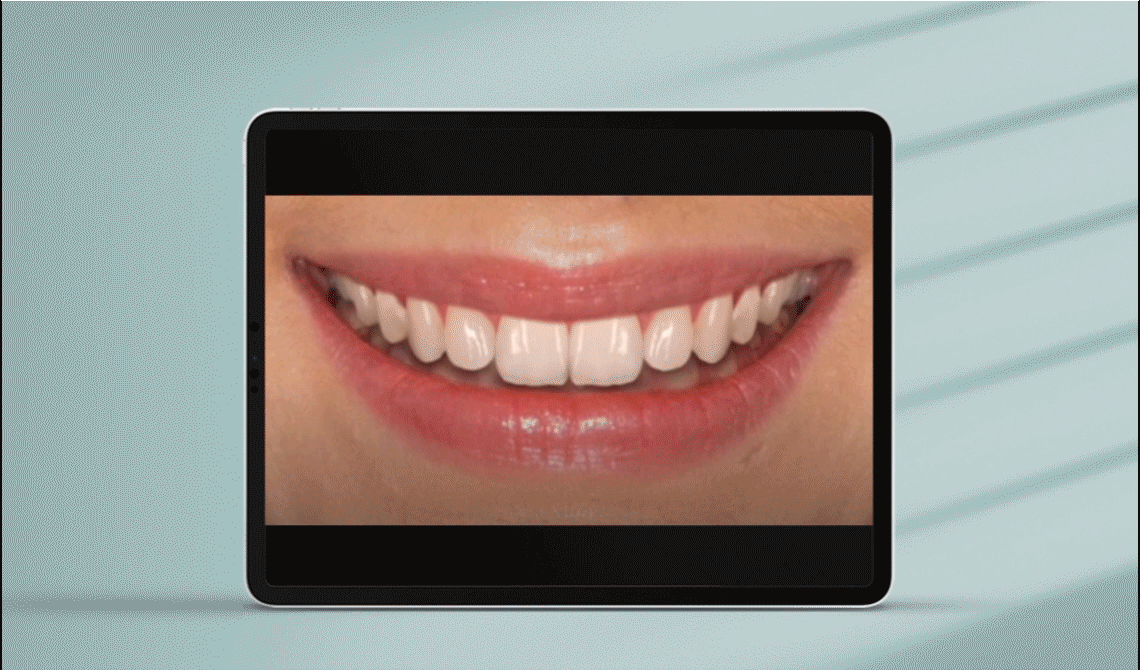 Digital Smile Design – cyfrowa wizualizacja uśmiechu