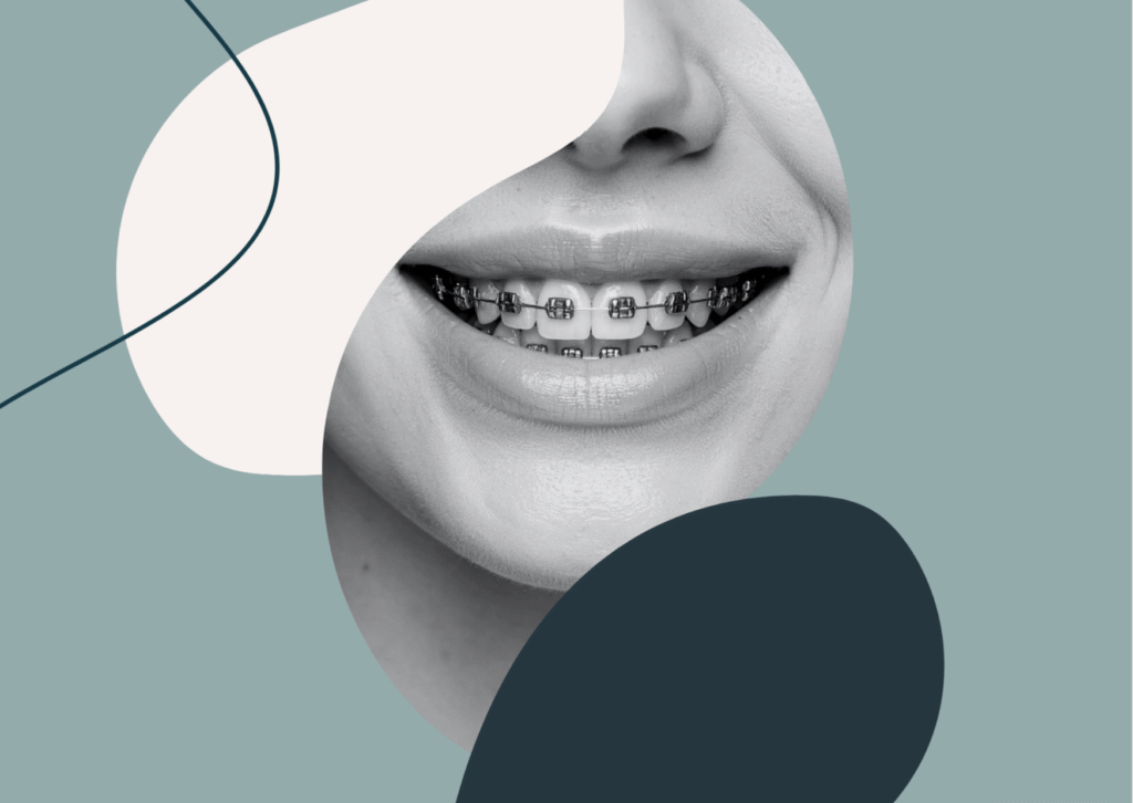 aparaty stałe ortodontyczne better warszawa